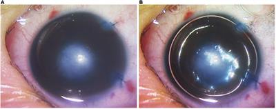 Selective endothelial removal: A case series of a phase I/II surgical trial with long-term follow up